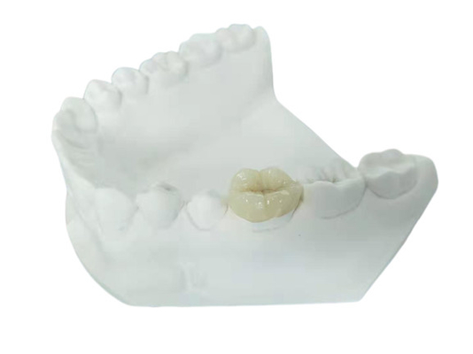 Onlay dentaire Tout-en céramique durable de marqueterie de placage de couronne de FDA semblable