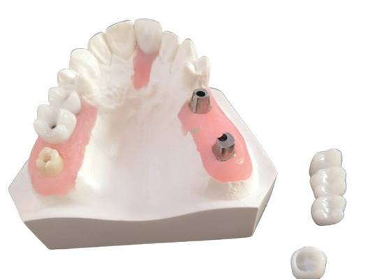 La couronne en zirconium avec dentition implantée pour laboratoire dentaire