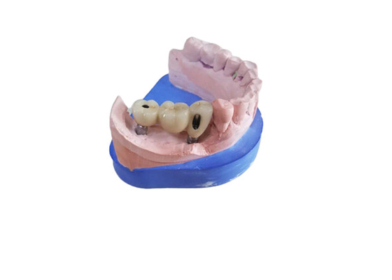 Couronne dentaire de zircone du DAO FAO avec la butée basse titanique de zircone