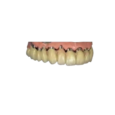 La couronne télescopique 3D dentaire de pont en couronne d'implant du DAO FAO PFM a imprimé des modèles