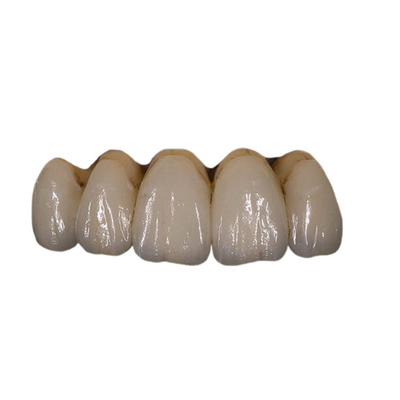Facile maintenez la stabilité de la couleur dentaire de couronne de porcelaine orthodontique de PFM