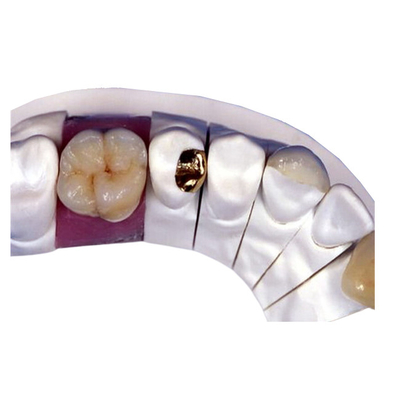 Couronne dentaire de porcelaine de PFM