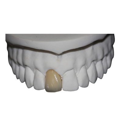 Couronne dentaire de porcelaine de Cr de Co