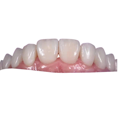 Couronne dentaire en céramique de blanchiment de 0.3MM pour remplacer les dents malsaines