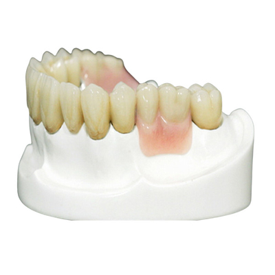 Prothèse de fixation de précision MK1 pour un ajustement et une protection parfaits