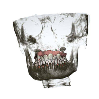 Extenseur palatal rapide d'OEM d'appareils orthodontiques démontables précis
