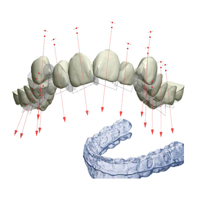 L'arrêtoir attache FDA a fixé l'appareil orthodontique avec 3D