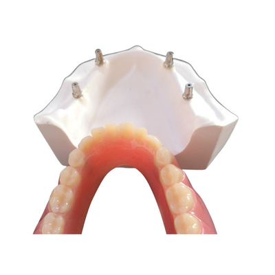 L'implant dentaire confortable Overdenture du DAO FAO facile maintiennent