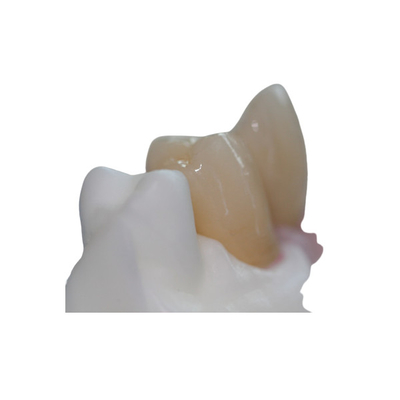 Butée faite sur commande de titane de barre pure démontable d'implant dentaire