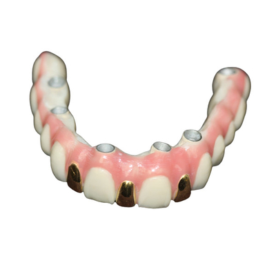 Précision Digital 3D imprimant le métal de barre d'implant dentaire basé
