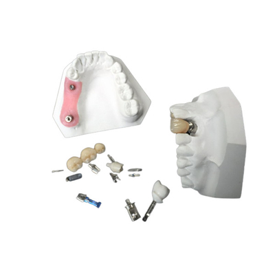 Haute couronne d'implant dentaire de zircone de longévité pour la restauration dentaire