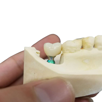 Couleur ultra dur l'OEM de stabilité la couronne d'implant que dentaire facile maintiennent