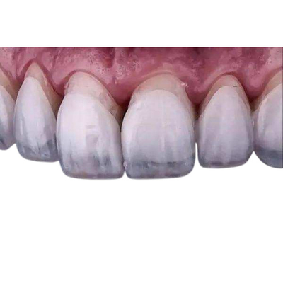 Placages fortifiants de couronne de zircone de laboratoire de dentiers dentaires dentaires de placages