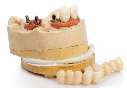 Implant dentaire titanique durable adapté aux besoins du client de rechange d'implant dentaire