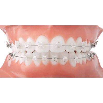 Beaux appareils orthodontiques fixes de parenthèse en céramique orthodontique propre facile