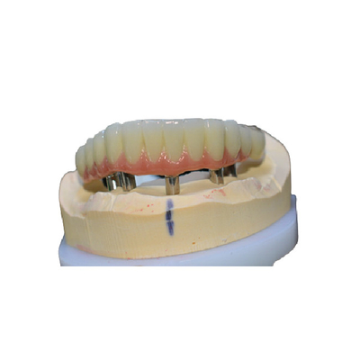 Couronne de nettoyage facile d'implant dentaire confortable aucune sensation de corps étranger