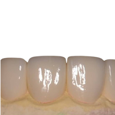 Les dents lisses de porcelaine ne plaque aucun beau placage blanc de porcelaine d'irritation
