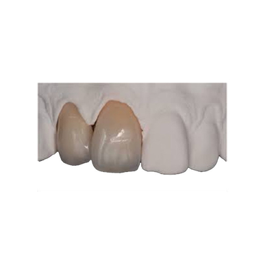 Restauration réaliste naturelle durable de couronne mince de zircone de force de corps