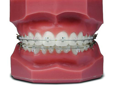 Appareils orthodontiques fixes confortables Belles parenthèses en céramique naturelles
