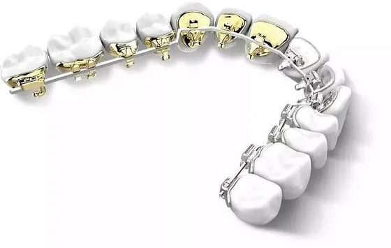 Appareils orthodontiques fixesAppareils orthodontiques fixes Dos latéral Bretelles linguales invisibles Esthétique Naturel