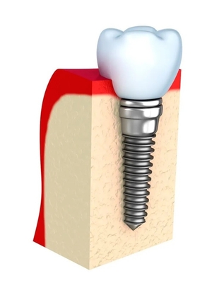 Prothèses dentaires temporaires barre d'implant dentaire simple toutes les dents en céramique