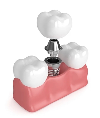True Dentures Implants Single All Ceramic Dentures Dents manquantes Remplissages