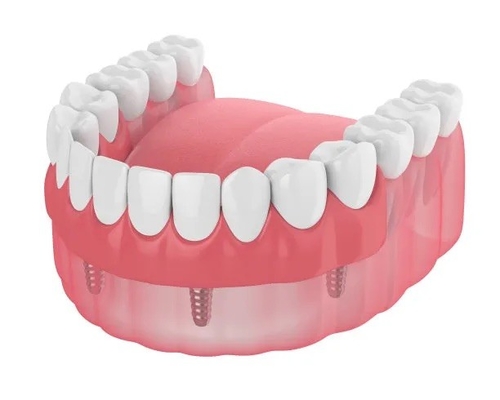 Prothèses dentaires Dents manquantes Implant dentaire Obturations sur barre Prothèses dentaires Prothèses amovibles temporaires