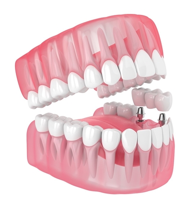 Dents Céramiques Uniques Implants Dentaires Remplissage Manquant Dents Dents De Sagesse