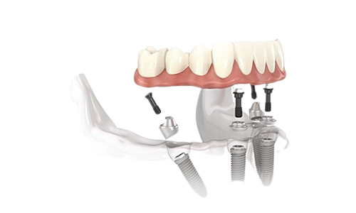 Prothèses Amovibles Invisibles Implants Remplis Restauration Complète Overdenture