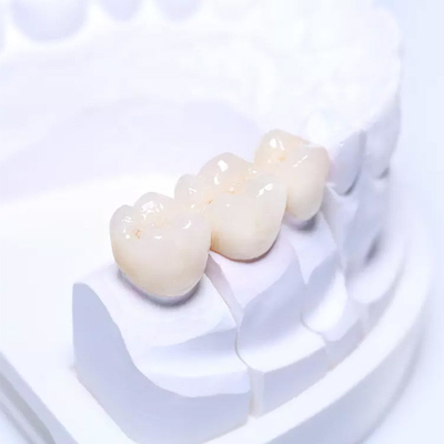 Assurance de haute qualité de pont dentaire partiel démontable extérieur lisse des dentiers PFM