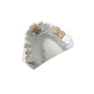 État de haute résistance d'OEM de couronne dentaire de porcelaine d'or jaune nouvel