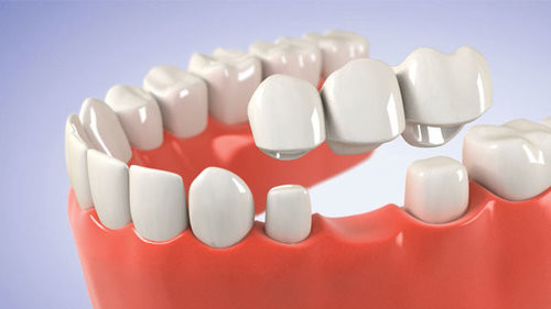 Couleur stable de couleur de Porcelai CrownRealistic non facile de casser la porcelaine