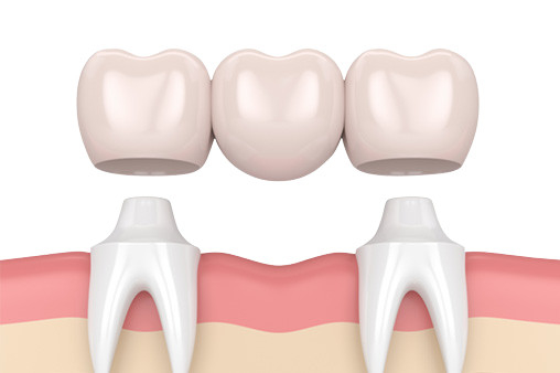Finition élevée élevée de résistance à l'usure de couronne de dent de porcelaine de sécurité d'hygiène buccale