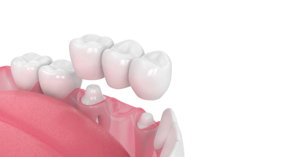 résistance à l'usure forte confortable non-irritante forte de pont en porcelaine