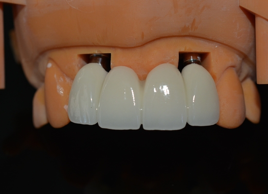 La force derrière notre succès nos techniciens de couronne d'implant dentaire