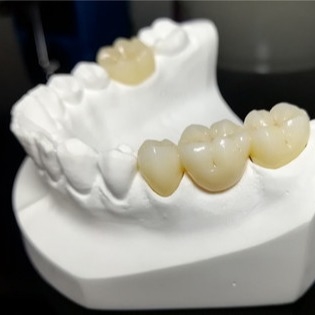 Qualité constante les couronnes de Mark Of Our Ceramic Dental