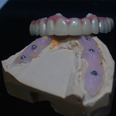 La personnalisation convenable parfaite dans des nos couronnes d'implant dentaire