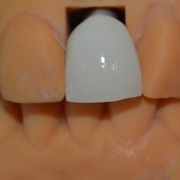 La force derrière notre succès nos techniciens de couronne d'implant dentaire
