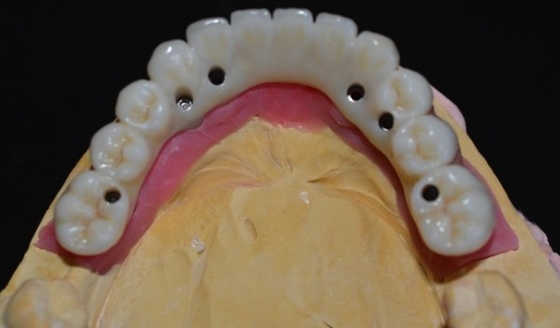 Élevant des normes notre garantie de la qualité de couronne d'implant dentaire