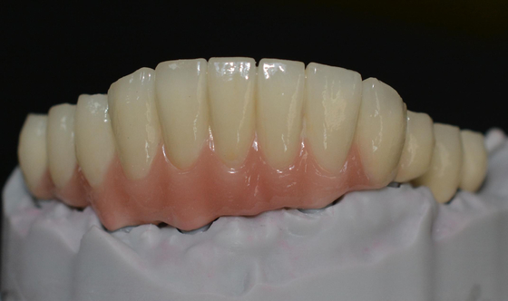 Embrassant les avancements technologiques l'avenir des couronnes d'implant dentaire