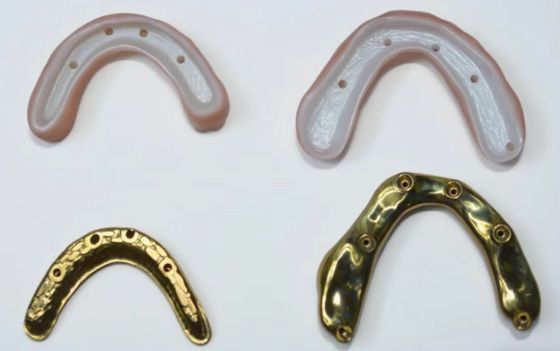Pont en zirconium complet avec support de barre de titane, couronnes en zirconium avec ponts avec support de barre de titane