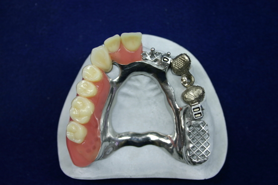Belle apparence Précision Prêtement Prothèse Prêtement Implant