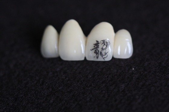 Personnalisation de l'image de la couronne dentaire avec des motifs personnalisés personnalisés