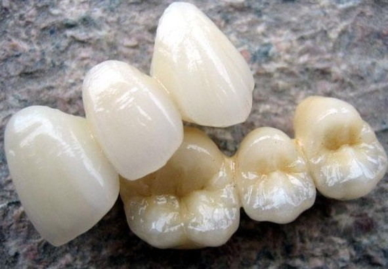 Haute porcelaine de couronne de Biocompatibility PFM fondue pour la restauration de dents arrières