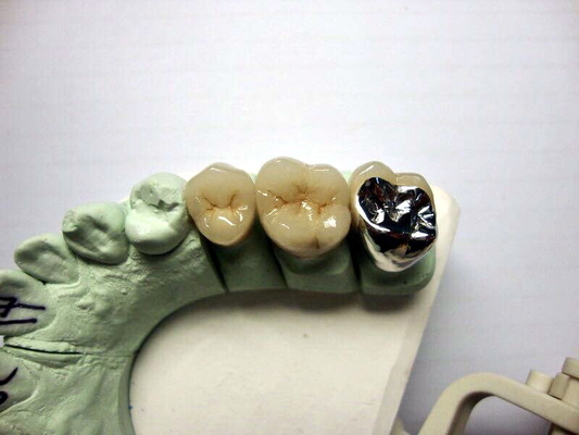 Haute porcelaine de couronne de Biocompatibility PFM fondue pour la restauration de dents arrières