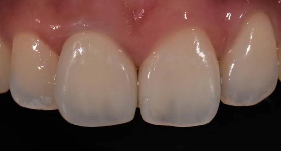 Haute porcelaine de couronne de Biocompatibility PFM fondue pour la restauration de dents arrières