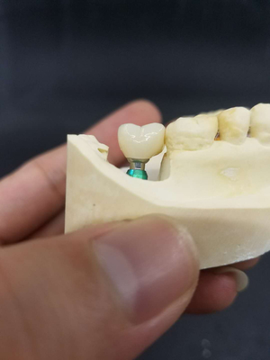 La couronne biocompatible extérieure lisse de dent de zircone facile maintiennent