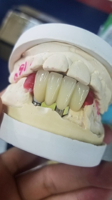 La couronne biocompatible extérieure lisse de dent de zircone facile maintiennent