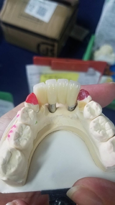 La couronne biocompatible extérieure lisse de dent de zircone facile maintiennent