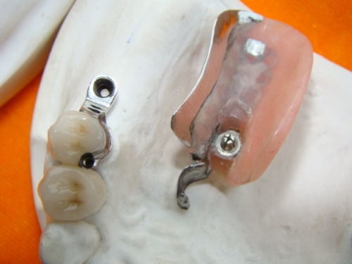 Le dentier durable d'attachement de précision de laboratoire dentaire souillent résistant